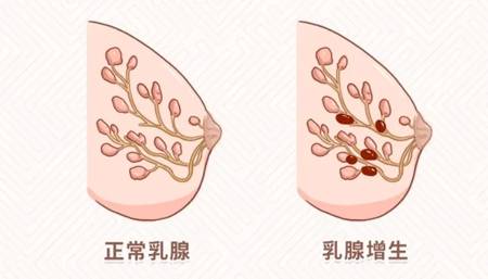 乳腺增生原来是这么回事儿！