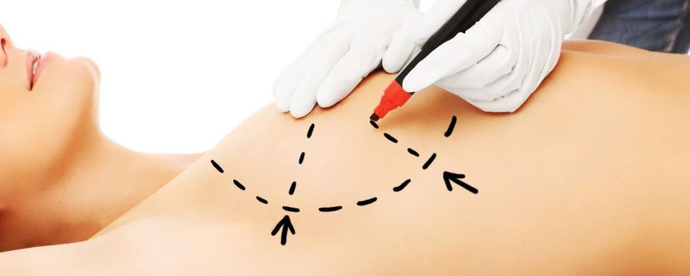 女人一生可以做多少次隆胸？