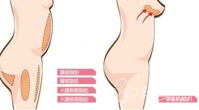 硅胶隆胸和自体脂肪隆胸信息介绍?