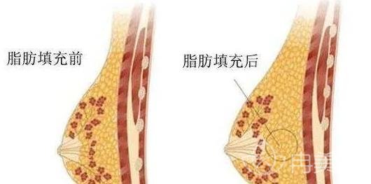 隆胸方式你更偏向于假体还是自体脂肪？有什么区别？