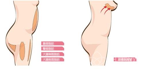 隆胸手术竟然存在这些你不知道的危害！