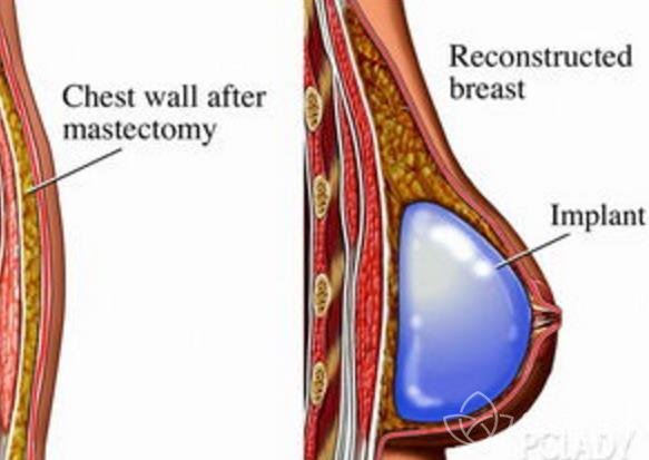 假体隆胸术后包膜挛缩怎么办？修复很重要！