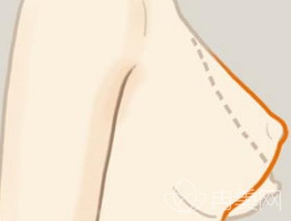 乳房出现下垂松弛的情况，赶快采用这种方式矫正！