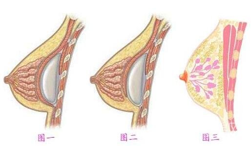 广州假体丰胸的费用是多少？自体脂肪和假体隆胸信息介绍？