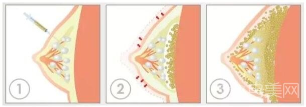 北京自体脂肪隆胸多少钱？