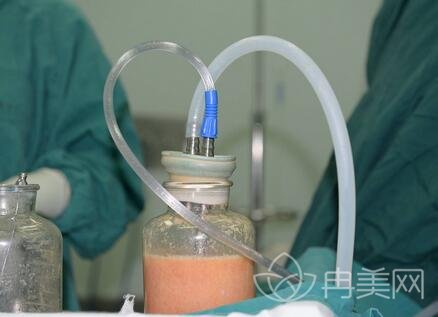 自体脂肪丰胸后怎么保养才能够更加自然？