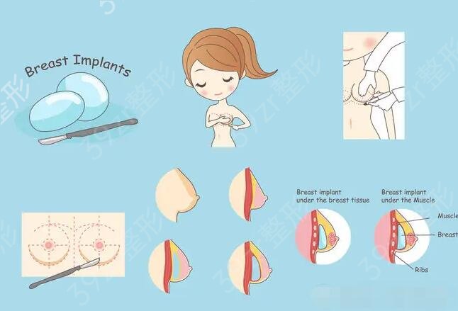 假体隆胸可以放一辈子吗？不知道的赶紧看过来！避坑指南已备好~