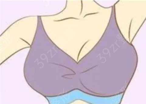 假体隆胸适宜哪些人群？多久可以变软？还有更多详情分享给大家