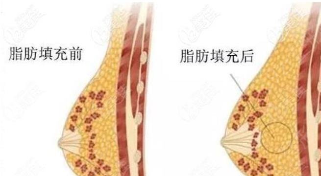 自体脂肪隆胸有没有优势？自体脂肪填充之后太痛怎么办呢?