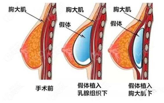 假体隆胸会影响健康吗?有副作用吗？