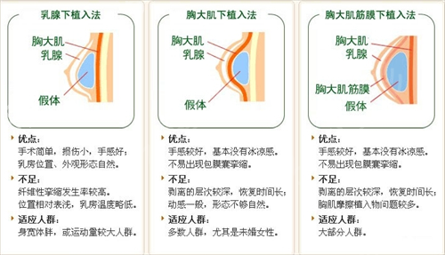 假体隆胸怎么样？果好吗？