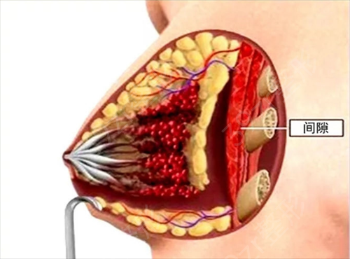 假体隆胸——赋予你体态