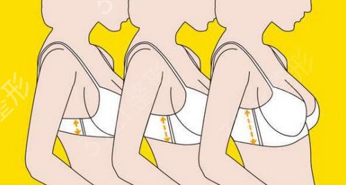 【隆胸日记】娜高假体隆胸没有硬感，很柔软很自然喔