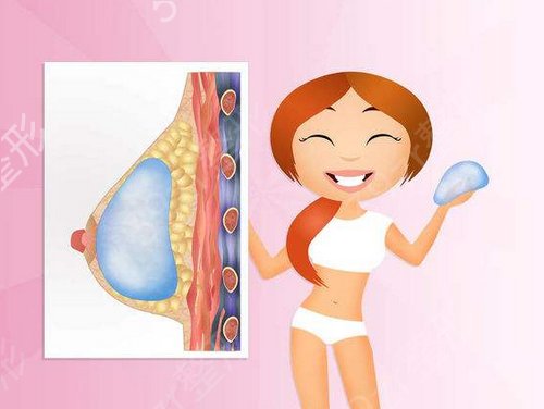 【隆胸日记】娜高假体隆胸没有硬感，很柔软很自然喔