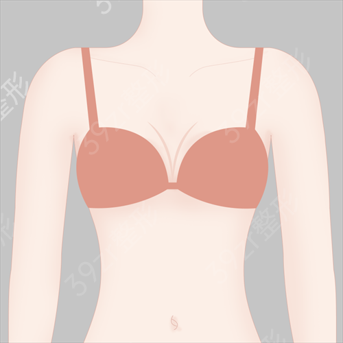 副乳吸脂*果吗？