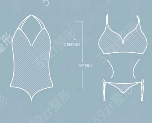 副乳吸脂会有后遗症吗？