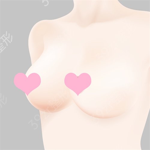 怎样做隆胸手术 隆胸手术是怎样做的