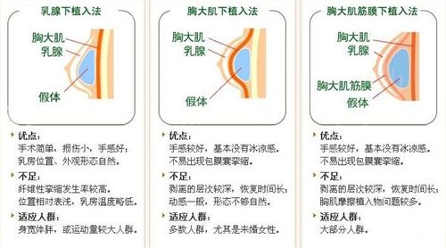 假体丰胸怎样?果自然吗?