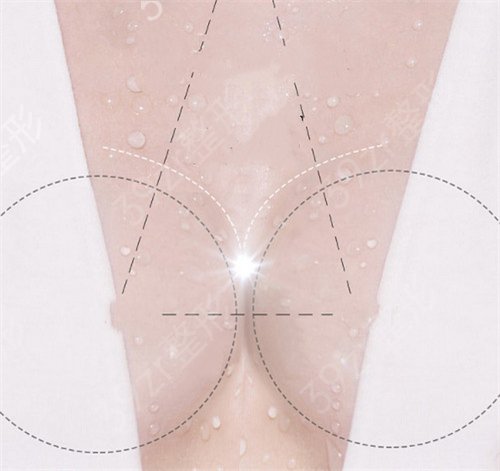 乳房再造手术要多少钱?保持时间及副作用普及