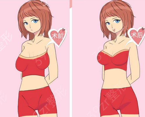 假体隆胸可以增大几个罩杯？术后多久胸部会变软？