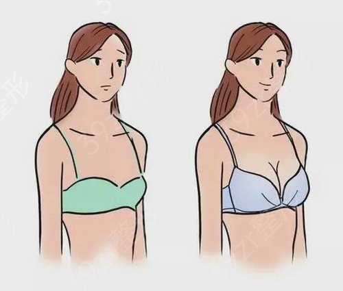 怎么去除假体隆胸后体内出现的积液？