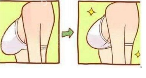 假体隆胸多久能完全消肿？哪种切口比较好？