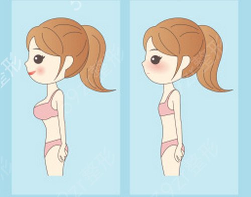 隆胸后假体感觉很硬是怎么回事？假体隆胸后如何快速变软呢？