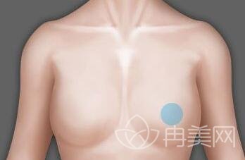 硅胶隆胸手术失败怎么解决？