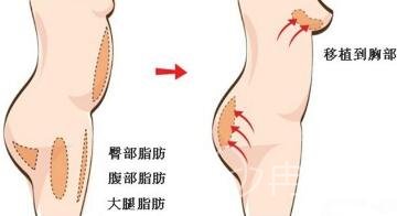 大腿抽脂加自体脂肪丰胸后可以吃什么？