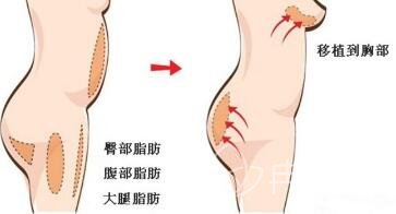 自体脂肪隆胸出现硬块的原因有哪些？摸起来疼怎么办？