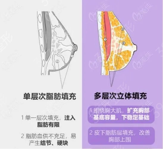 乳房畸形矫正手术流程?乳房下垂的危害有哪些?
