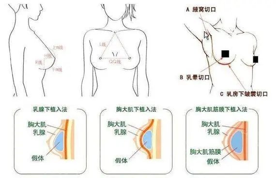 乳房畸形矫正手术流程?乳房下垂的原因是什么?
