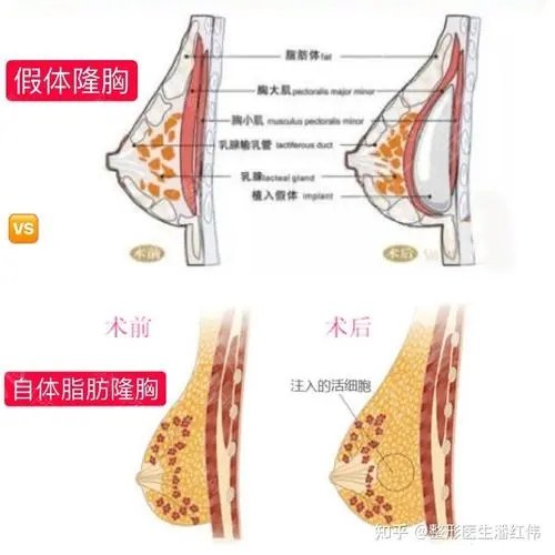 上海吸脂隆胸多少钱?吸脂隆胸贵吗?