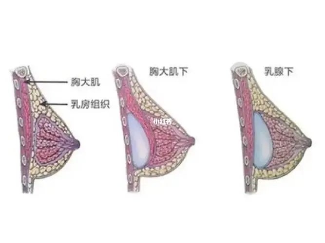 上海隆胸手术?丰胸手术应该注意什么?