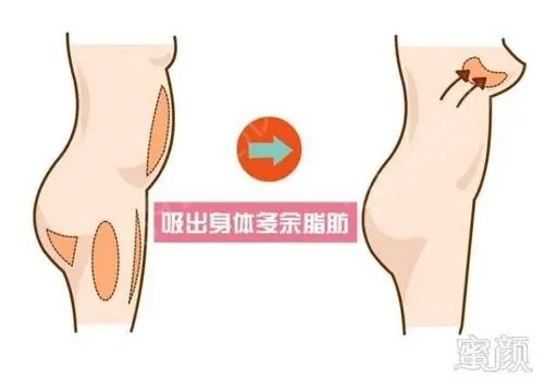 做丰胸一般要多少钱?丰胸手术有哪些方法?