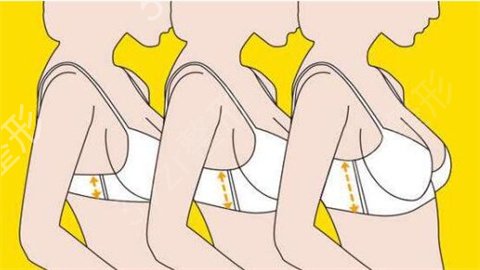 做双平面假体隆胸除了不需要按摩外，原来优点这么多！