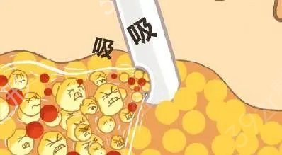 吸脂隆胸手术果怎么样？这些危害劝你提前了解一下
