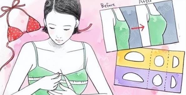 自体脂肪隆胸与假体隆胸信息介绍？会影响哺乳吗？