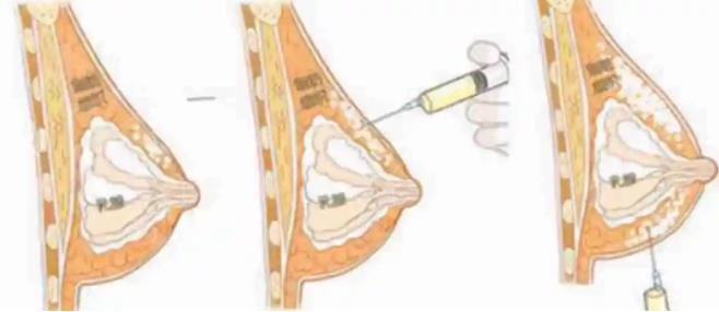 自体脂肪隆胸靠谱吗，一次可以增加两罩杯以上吗