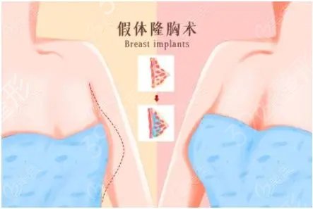 脂肪隆胸or假体隆胸怎么选?不纠结!优缺点一目了然