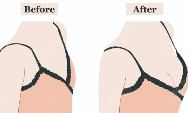 决定做假体隆胸，该如何选择材料?假体一定会破裂吗？如何避免？