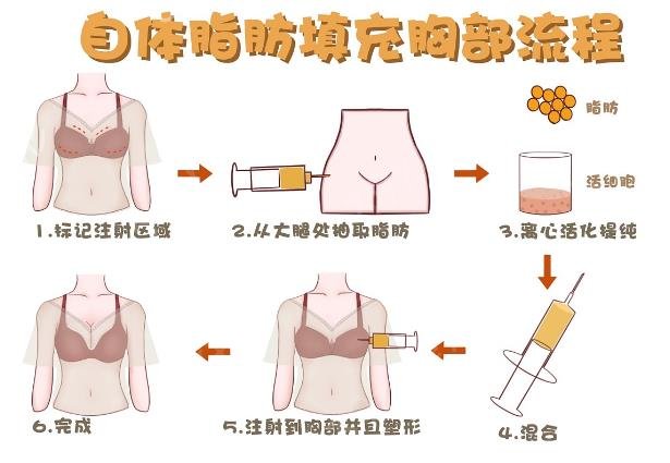 脂肪填充胸部有什么危害？脂肪填充胸部的危险性