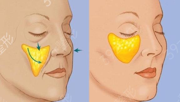 做脂肪填充多少钱?脂肪填充价格查询