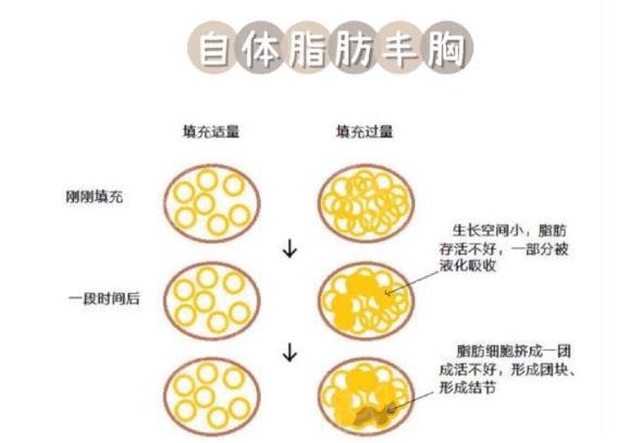 字体脂肪填充胸部多少钱？字体脂肪填充胸部新美容热门做法