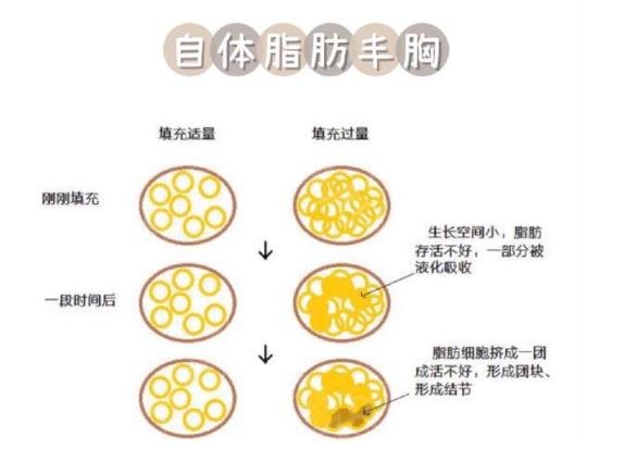 脂肪填充胸部一次就有效果吗？附详细介绍