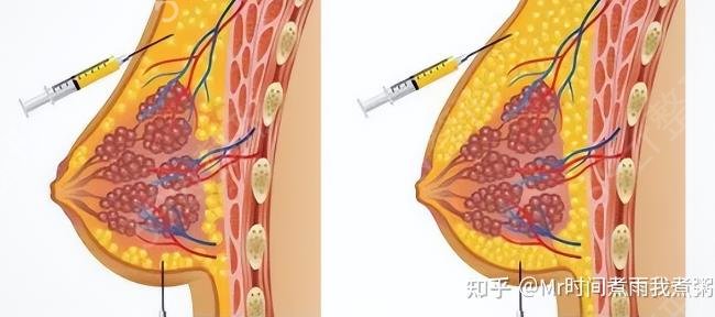 脂肪填充胸部和假体隆胸哪个好？脂肪填充胸部和假体隆胸的优缺点比较