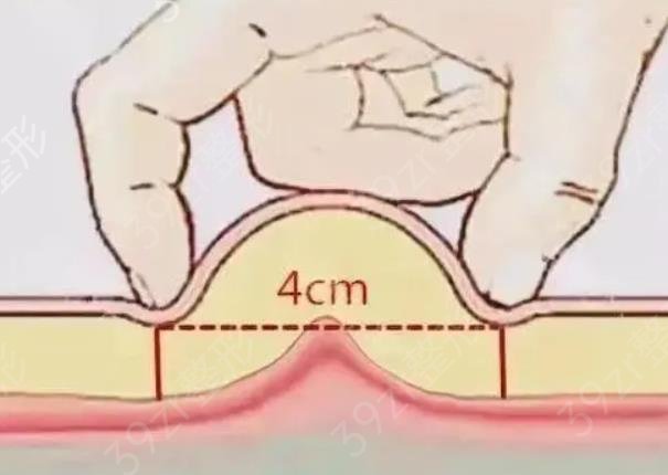 脂肪填充胸部多久可以填第二次？脂肪填充胸部需要注意的事项
