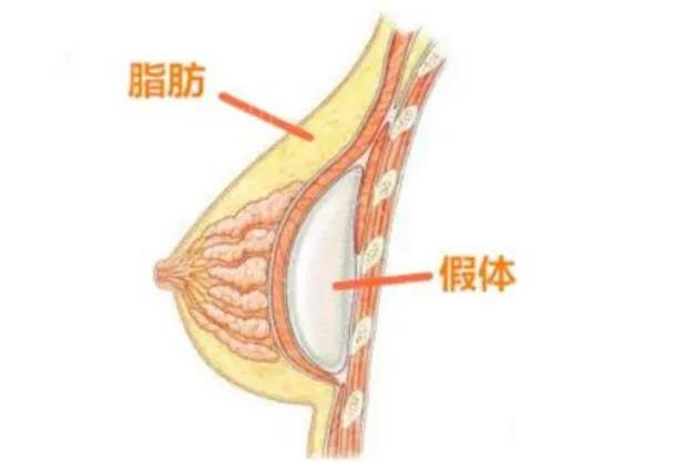脂肪填充胸部多久恢复自然？脂肪填充胸部手术后的恢复时间