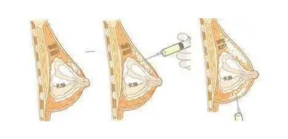 脂肪填充胸部多久可以摸？脂肪填充胸部后需要注意的事项