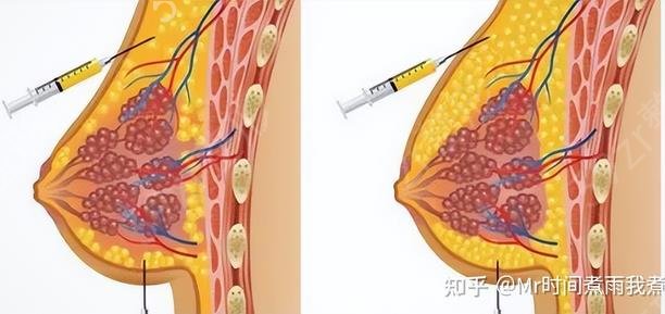 脂肪填充胸部成活率是多少？脂肪填充胸部的成活率